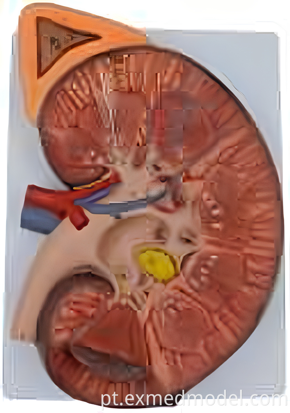 Enlarged Kidney Anatomy Model